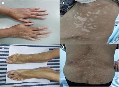 Vitiligo-like lesions induced by cyclin-dependent kinase 4/6 inhibitor Palbociclib: a case report and literature review
